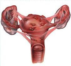 лікування ендометриту під час вагітності