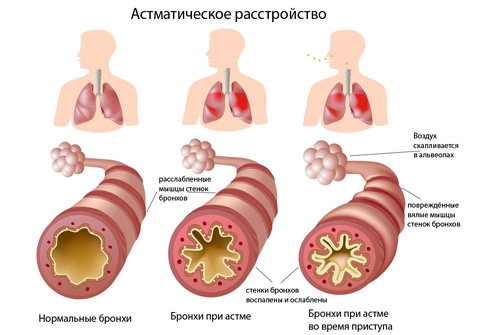 астматичний розлад