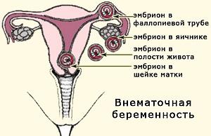Дослідження при позаматкової вагітності