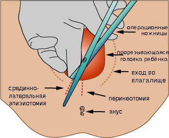 перинеотомия (епізіотомія)