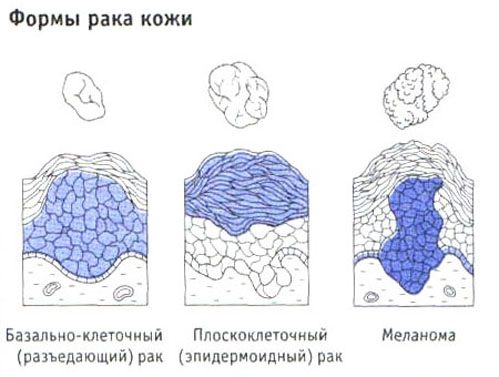 форми раку шкіри