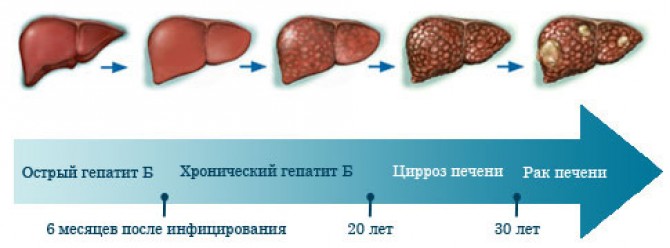 гепатит печінки