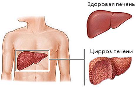 симптоми цирозу печінки і лікування