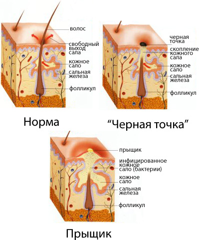 нормальний стан шкіри на грудях і прищі (акне)