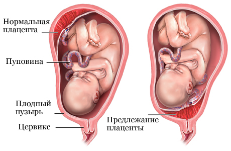 нормальна плацента и передлежання плаценти