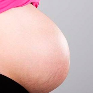 причини з'явилася розтяжок при вагітності