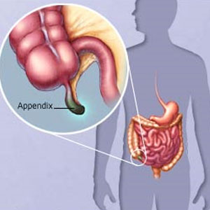 симптомы аппендицита